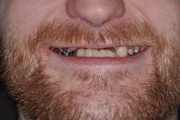 Smile In a Day 5 before